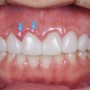 무삭제라미네이트 부작용 : 만성잇몸염증(부음&출혈), 삭제량 없는 것의 치명적 단점 - 과풍융보철물&생물학적폭경