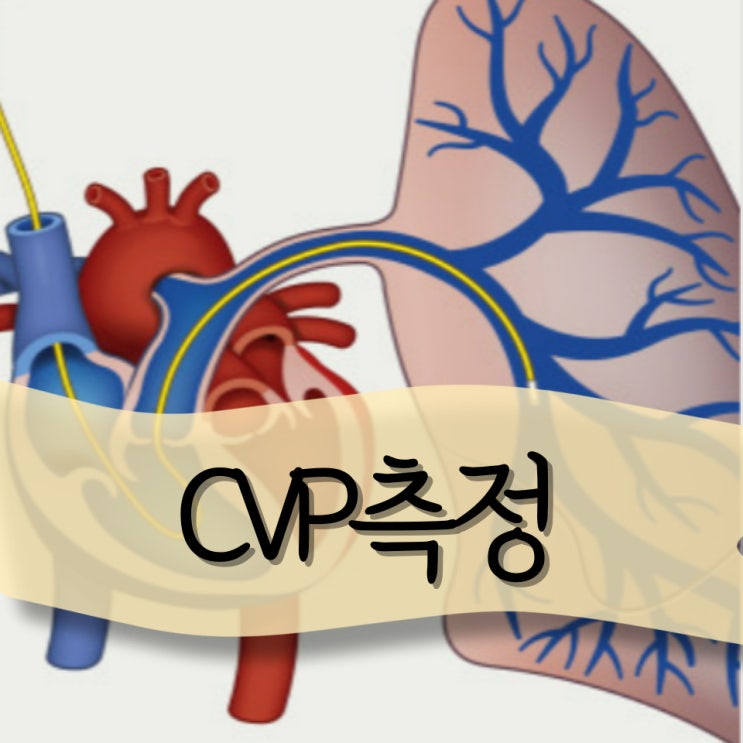 CVP측정 언제 왜 어떻게 : 중심정맥압 : 네이버 블로그