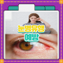 눈병 유행 전염 및 결막염 원인 증상 예방법