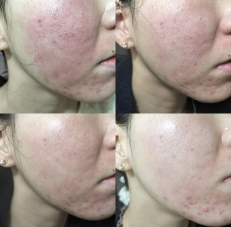 얼굴 홍조 원인 피부 열감 가라앉힌 안면 홍조 크림 : 네이버 블로그