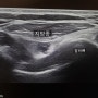[Dr.ParK] 갈비뼈 사이에 발생한 지방종 제거 수술