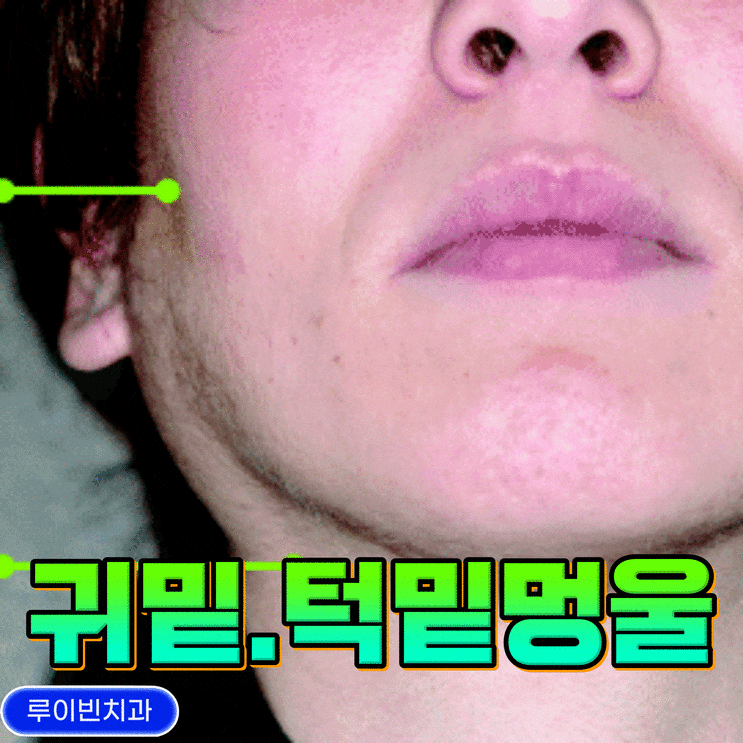 귀밑 멍울 턱밑 몽우리, 침샘염 증상 원인치료 병원 : 네이버 블로그
