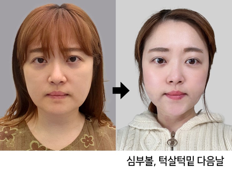 심부볼+턱살턱밑 다음날 붓기(feat. 심부볼후기) : 네이버 블로그