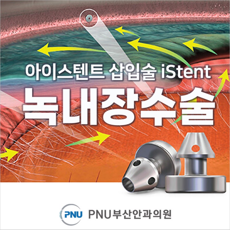 온천장역 안과 / 녹내장수술 아이스텐트iStent 삽입술이란? : 네이버 블로그