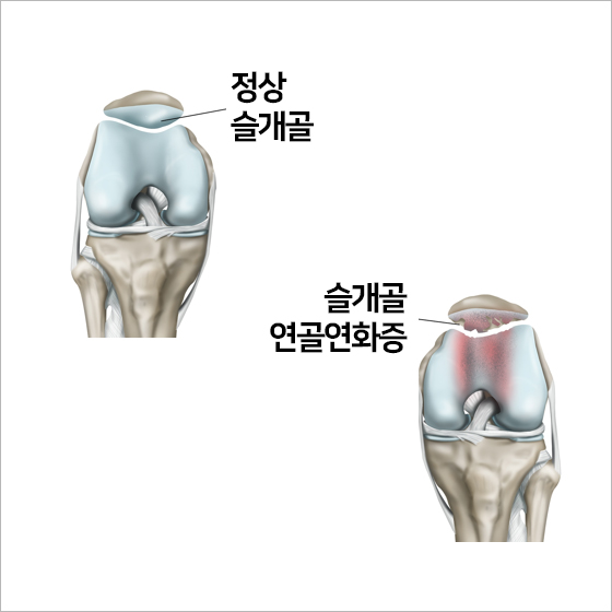 슬개골 연골연화증은 무릎이 아픈 거랍니다. : 네이버 블로그