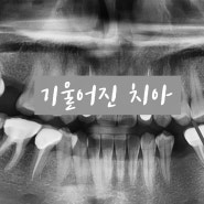 당산동 치과 치아 교정 및 임플란트 둘 다 받으셔야 가능했던 임상 증례