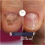 (손톱)조갑이영양증 진균과 손톱 곰팡이의 관계