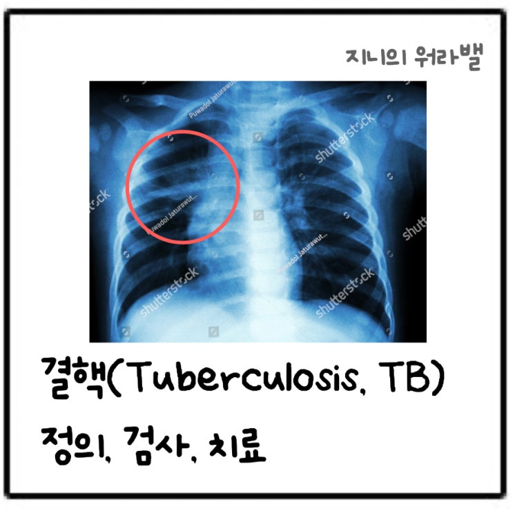 결핵(Tuberculosis), 잠복결핵, 폐결핵, 결핵검사, 결핵치료, 결핵에 걸렸을 때, 이소니아자이드, 리팜핀, 결핵약 ...