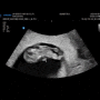 임신초기 임신 8주증상 9주증상 (젤리곰)