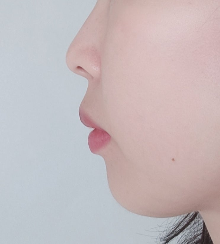 [리뷰] 보턱스 전후 / 후기추가 / 보툴렉스 자갈턱 후기 / 구미 보톡스 / 내돈 내산 : 네이버 블로그