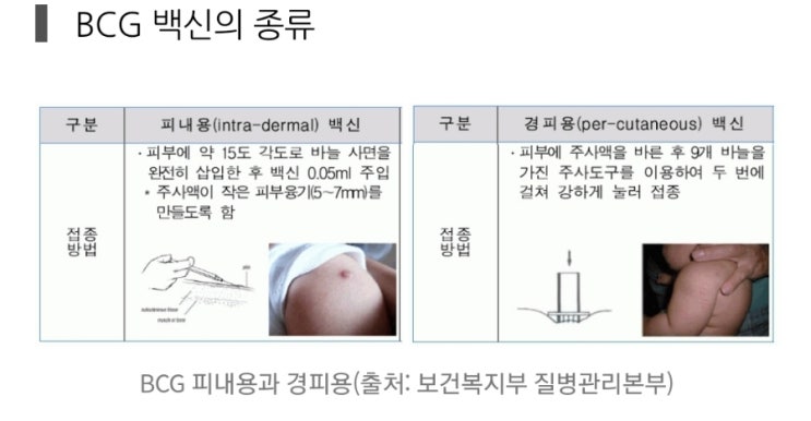 철원 BCG | 생 후 한달 이내 | 철원소아과 | 경피용? 내피용? | 조리원에서 해야 할 일들 : 네이버 블로그