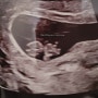 미국 임신, 미국 출산 8주: 미국에서 첫 산부인과 방문