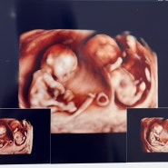 쌍둥이 젤리곰, 입체 초음파 및 주차별 임신 기록과 출산