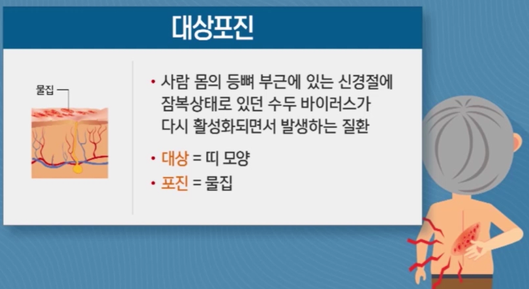 39. 대상포진 : 네이버 블로그