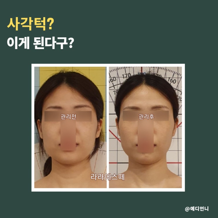 사각턱관리는 라라에스떼에서 두골비로 해결하세요! : 네이버 블로그