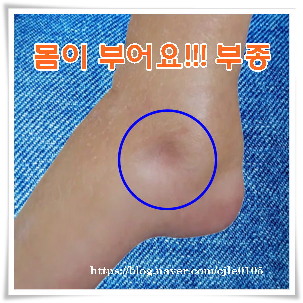 몸이 보내는 건강 적신호일까? 몸이부어요! 부종 붓기 몸이붓는이유와다리부종 : 네이버 블로그