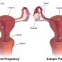 자궁외임신 위험을 낮추는 유산후한약에 대하여(광주 광산구 수완지구 느티나무한의원)