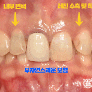 달서구 치과 에서 전치부 치아에 나타난 여러 문제들을 개선해드렸던 스토리