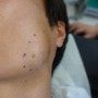 [Dr.ParK] 얼굴에 발생한 지방종 흉터가 작게 핀홀법 제거 수술