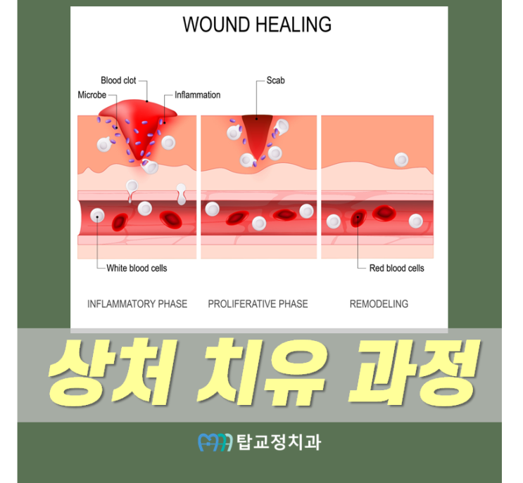 상처(창상, wound) 치유 기전, 종류, 과정 : 네이버 블로그