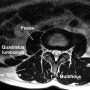 multifidus (다열근)