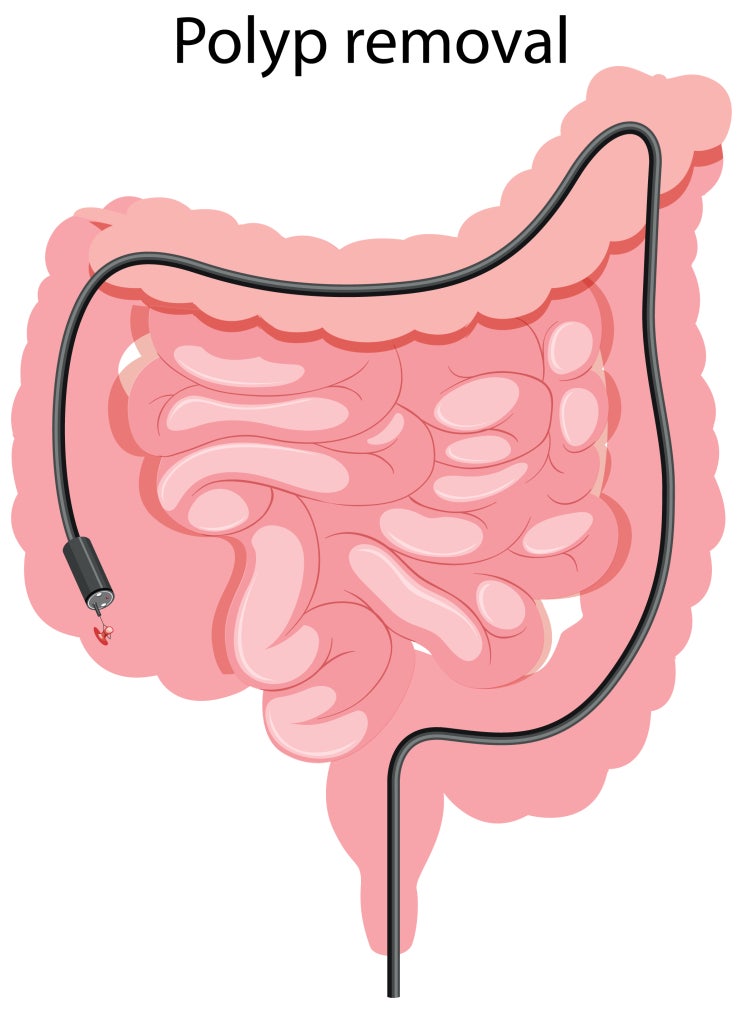 대장 용종 - 증식폴립(과형성 용종, Hyperplastic polyp) // 당일 용종절제술 가능한 하남대장내시경 검사 의료 ...