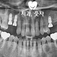 축농증 치성부비동염 심할 때 상악동 거상술 임플란트 웃자치과 고려사항