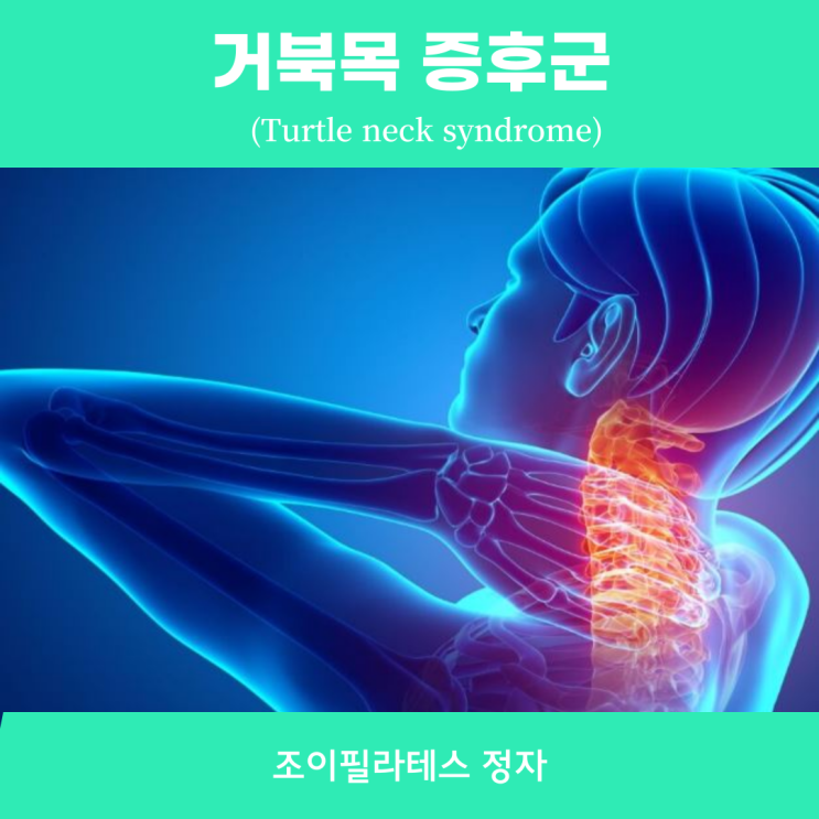 [정자역 조이필라테스] 거북목 증후군 (Turtle Neck Syndrome) : 네이버 블로그