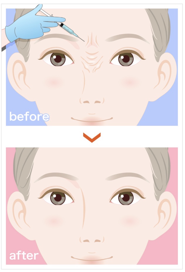 얼굴 이마 주름 미간 보톡스 뜻 효과 통증 가격 부작용? : 네이버 블로그