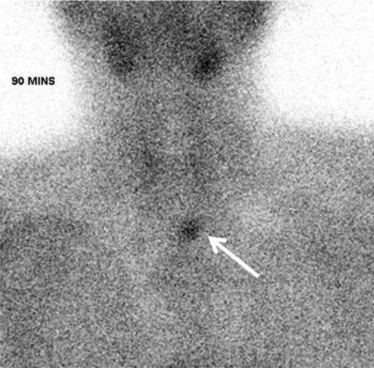 흉선종 조직검사 암일 확률 악성 종양 흉선암 생존율 생존기간? : 네이버 블로그