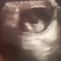 [임신일기] 2차기형아검사