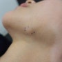 [Dr.ParK] 턱에 발생한 신경초종(schwannoma) 제거 수술