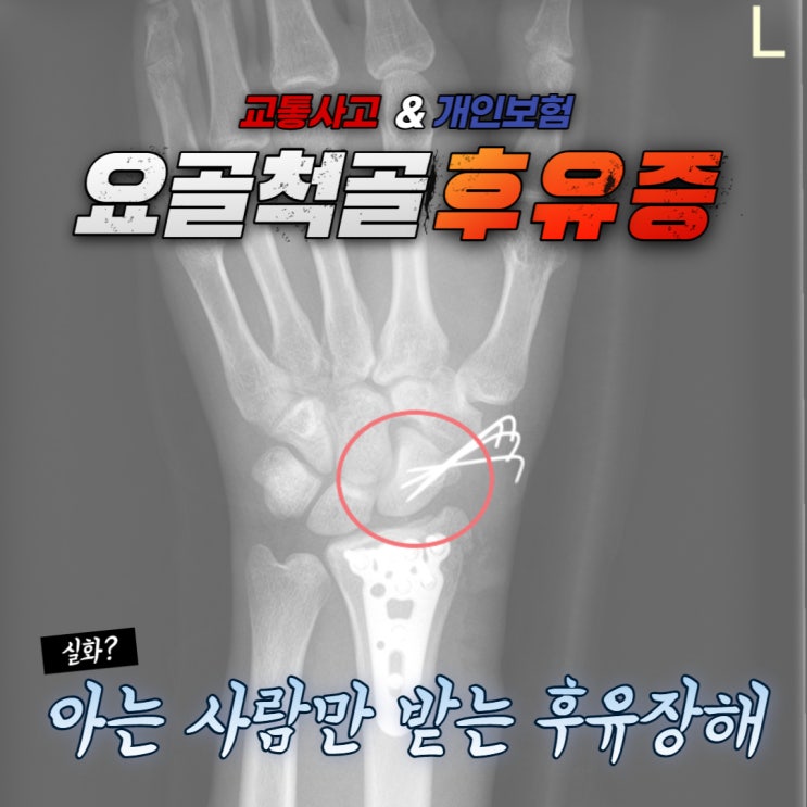요골 척골골절 알아야 받는 후유장해보상 : 네이버 블로그