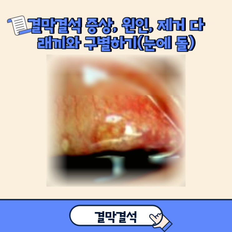 결막결석 다래끼와 구별하기(증상, 원인, 제거) : 네이버 블로그