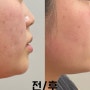 광주 상무지구 피부과 : 인모드fx + 슈링크 솔직후기 / 부작용
