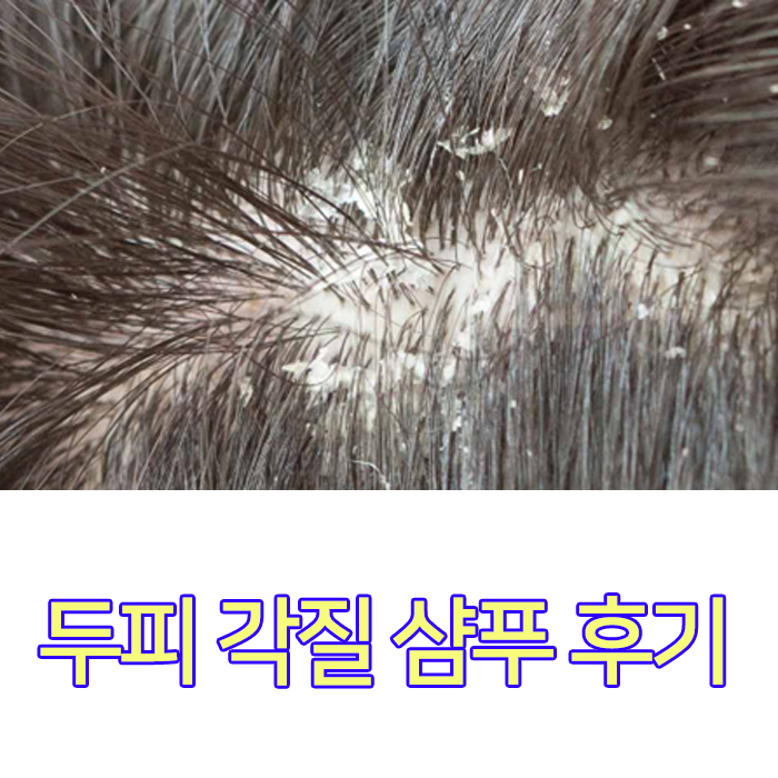 두피 각질 샴푸 써야하는 이유 : 네이버 블로그