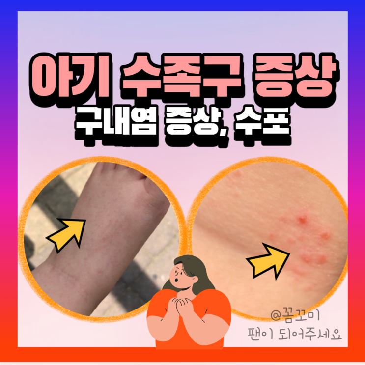 수족구초기증상 수포, 아기 구내염증상 약 격리기간 : 네이버 블로그