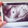 임신 5주차 : 아기집 초음파, 임신 초기 증상, 임테기 역전, 출혈, 주근깨, 입덧, 체덧, 이명, 가슴 통증