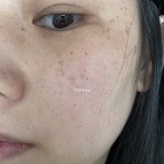 성북구 피부과/미아사거리 피부과::주근깨 기미 잡티제거&물광주사(내돈내산)