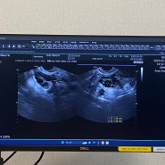 [임신 일기 05] IVF-M HP (메노트로핀에이치피) 주사 6번 맞고 초음파