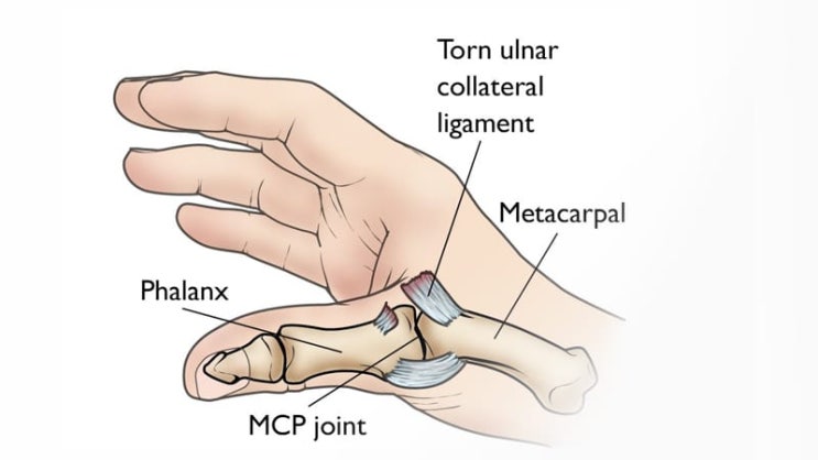 [OS] Thumb UCL repair : 네이버 블로그