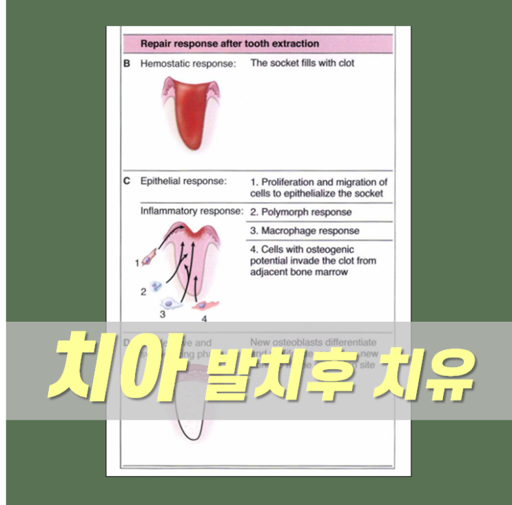 발치 후 치유, 발치후 주의사항 장성 보성 치과 : 네이버 블로그