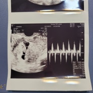 임신5~7주 기록(갈색혈/하루종일 두통/입덧시작!)