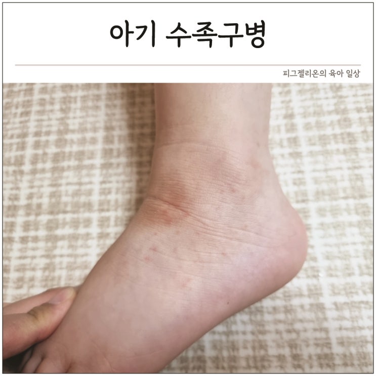 아기 수족구 잠복기 초기 증상 수포 어린이 수족구병 전염 기간 : 네이버 블로그