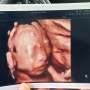 [임신일기] 정밀초음파
