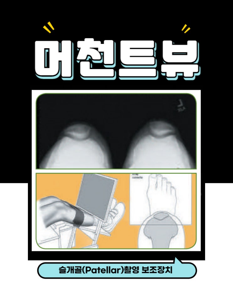 머천트 뷰 Merchant Radiograph View : 네이버 블로그