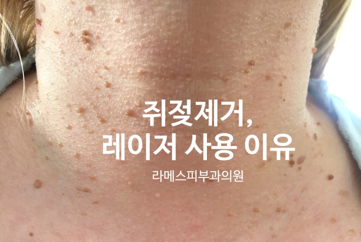얼굴, 목, 겨드랑이 쥐젖 제거 (연고 X, 레이저 O) : 네이버 블로그