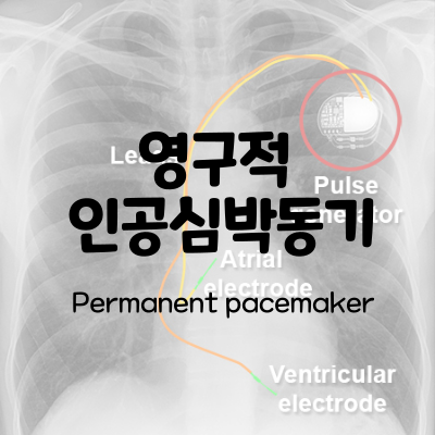 영구적 인공심박동기의 적용 Permanent Pacemaker, PPM : 네이버 블로그