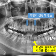 측절치결손,임플란트없이진행- 치아교정전문 이세현치과