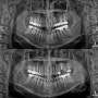 방배/내방 임플란트 치과, 상악동거상술을 통한 뼈이식 동반 임플란트는 방배역치과 더강한치과에서.